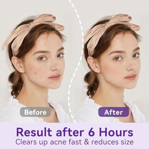 OmaDoto Overnight Pimple Patches for Face -（10mm & 12mm | 72 Count | 6 Sheets） - Hydrocolloid Patches with Salicylic Acid, Long-Wear Zit Stickers for Teens & Adults, Day & Night Use - Thumbnail 2