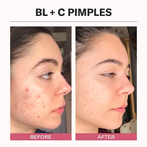 Odacité Bl+C Serum Concentrate for Face, Luxury Black Cumin + Cajeput Pore-Clearing Facial Oil for Pimples & Blemishes, Vegan Vitamin E Spot Treatment for Oily, Acne-Prone Skin, 0.17 fl oz - Thumbnail 5