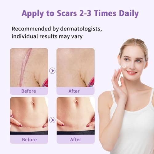 Yarster Silicone Scar Gel Scar Cream, Treats Old and New Scars, Stretch Marks Removal Formula Helps from Surgical, Burns, Acne Scar Treatment with Advanced Scar Gel, 1.7 oz (50ml) - Thumbnail 5