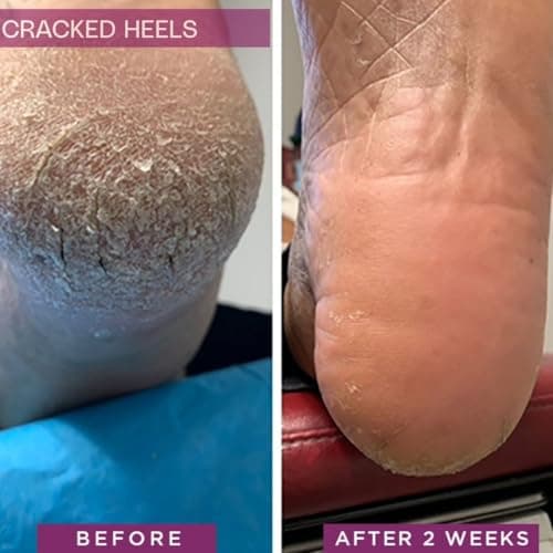 SkinIntegra Rapid Crack Repair Cream, 25% Urea with Lactic Acid, Heals Cracked Heels and Diabetic Feet, Post-Surgery Scar Care, Fragrance-Free Barrier Cream, 3 oz - Thumbnail 3