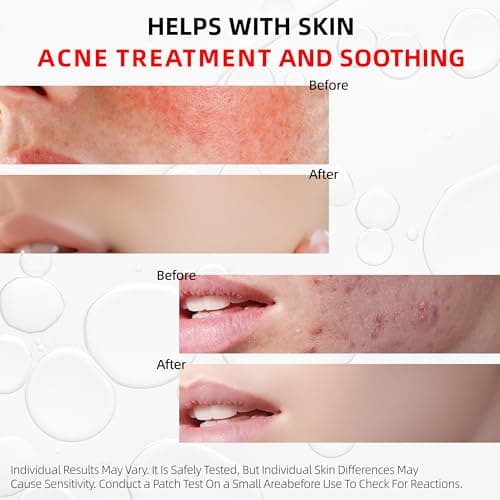 HKY Acne Serum, Salicylic Acid (BHA) + PHA + PAD, Redness Relief in 90 Mins, OTC Formula with Rice Ferment & Centella & Niacinamide, Pore Minimizer & Post-Acne Mark Treatment, Acne-Prone Skin [20ml] - Thumbnail 6
