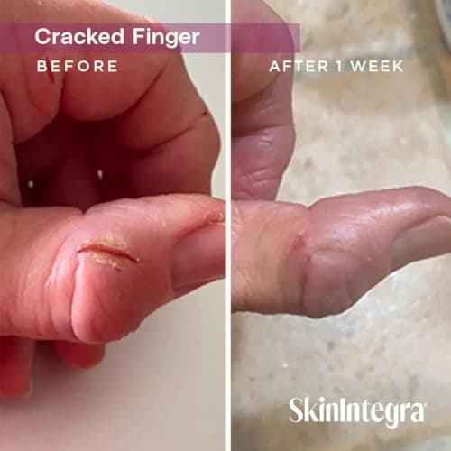 SkinIntegra Rapid Crack Repair Cream, 25% Urea with Lactic Acid, Heals Cracked Heels and Diabetic Feet, Post-Surgery Scar Care, Fragrance-Free Barrier Cream, 3 oz - Thumbnail 4