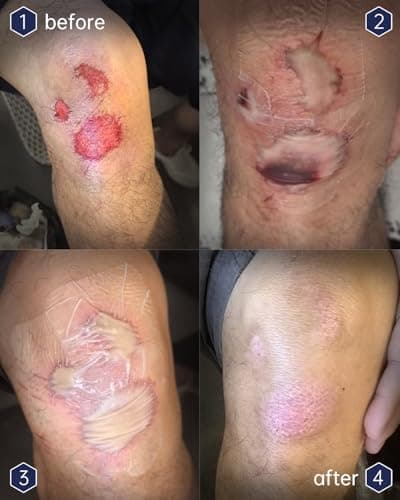 yehooheal Hydrocolloid Adhesive Bandages Dressing,0.004inch Ultra-Thin Skin-Like Waterproof Faster Healing Patch,for Outdoor Sports First Aid Wound Care Sensitive Skin(3.15in*3.15in, 2Count) - Thumbnail 3