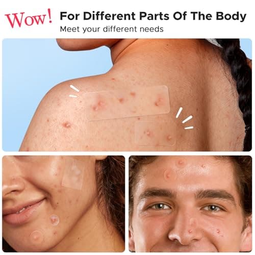 LitBear Large Pimple Patches, 5 Sizes 324 Patches Big Acne Patches, XL Hydrocolloid Bandages for Full Face, Forehead, Chin, Nose, Body, Back, Neck & Chest, Stirp, Square Large hydrocolloid Patch - Thumbnail 3