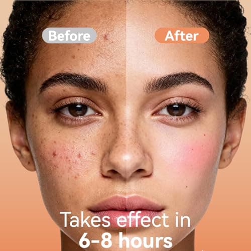 OmaDoto Microdart Pimple Patches for face - 6 Count - Micropoint with Salicylic Acid - Translucent Hydrocolloid Blemish Covers & Hydrocolloid Circles - Thumbnail 6